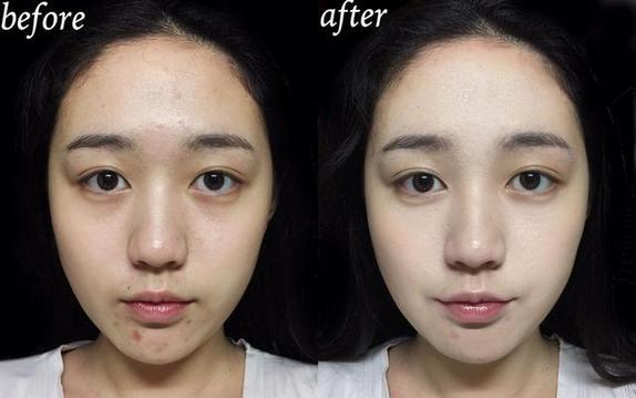 春节吃太好脸上爆痘怎么办?一招快速拯救节后上班的妹纸 春节吃太好脸上爆痘怎么办?一招快速拯救节后上班的妹纸