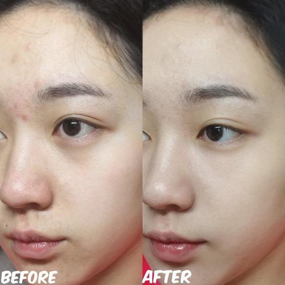 春节吃太好脸上爆痘怎么办?一招快速拯救节后上班的妹纸 春节吃太好脸上爆痘怎么办?一招快速拯救节后上班的妹纸